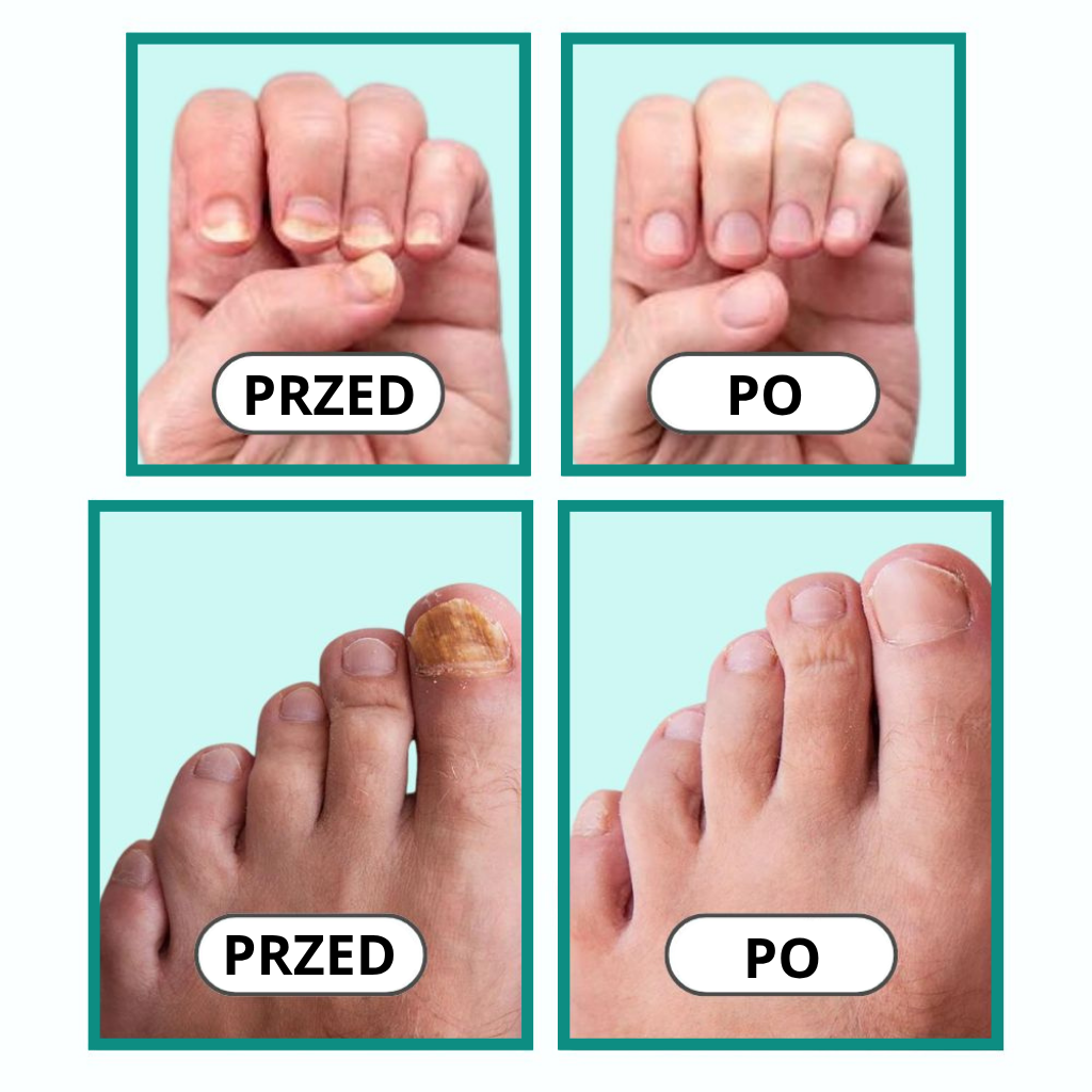 Footilix™ - Pożegnaj grzybicę