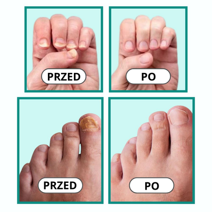 Footilix™ - Pożegnaj grzybicę